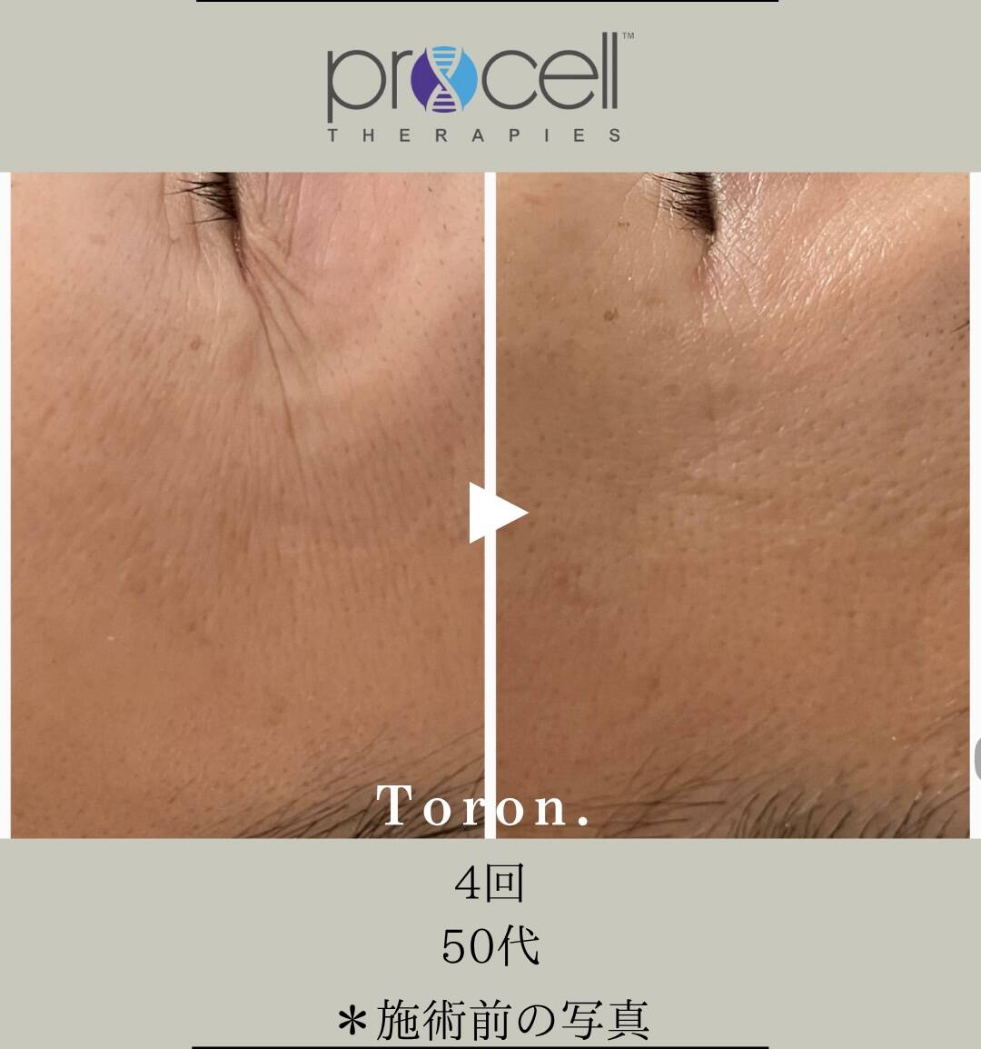 procellフェイシャル | Toron.